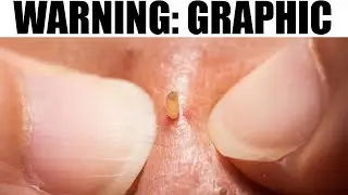 Blister Popping, Tonsil Stones, Open Comedones, Fissured Tongues & Blackhead King