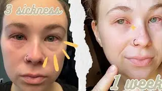 A cold, double eye infection and laryngitis…