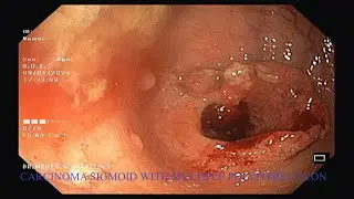 Metastatic carcinoma sigmoid colon| Multiple polyposis colon| Colonoscopy| Biopsy| FAP