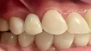 ¿CÓMO RESOLVER UN CASO DE ATROFIA EXTREMA EN ZONA ESTÉTICA EN SOLO 24H?