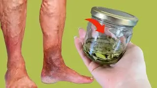 Incredibly! Erases varicose veins like an eraser! It's a varicose vein killer!