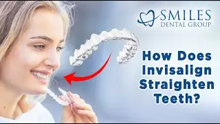What is Invisalign? How Does It Straighten Teeth?