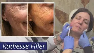 Radiesse Filler [Calcium Hydroxylapatite (CaHA) Injections]