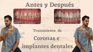 Tratamiento de coronas e implantes dentales