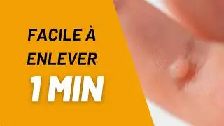 Comment ENLEVER des VERRUES