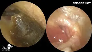 1,557 - Cholesteotoma, Auto-Atticotomy, Head & Neck of Malleus Exposed - Patient Saw Sales Assistant