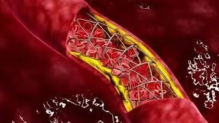 Carotid Artery Disease (CAD)