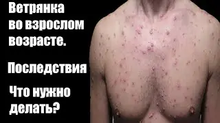 ВЕТРЯНКА У ВЗРОСЛЫХ! ПОСЛЕДСТВИЯ ВЕТРЯНОЙ ОСПЫ ВО ВЗРОСЛОМ ВОЗРАСТЕ! ВЕТРЯНКА У ВЗРОСЛЫХ ЧТО ДЕЛАТЬ?