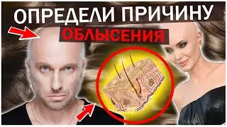 Как Остановить Облысение?! ПРИЧИНЫ ОБЛЫСЕНИЯ В 2021 году