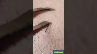Thick Ingrown Hair Removed  #인그로운 헤어 #ingrownhair #Shorts