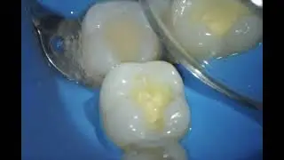 Substituição de Resina Sem Sensibilidade