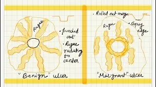 High yield info - ulcer of peptic ulcer vs ulcer in gastric ca v.impt ✅key points covered