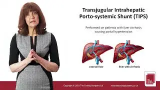 Training Video: Transjugular Intrahepatic Porto-systemic Shunt (TIPS) explained