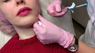 Контурная пластика нижней трети лица
