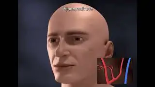 weebl's brain aneurysm