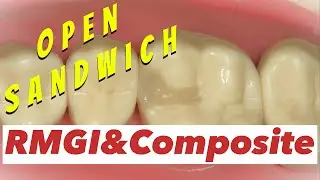 open sandwich technique 4K