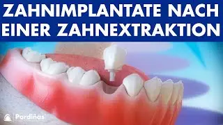 Zahnimplantate nach einer Zahnextraktion ©