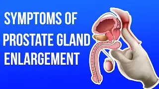 Symptoms & Signs Of Prostate Gland Enlargement