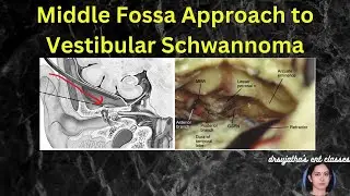 246.Middle Fossa Approach for Vestibular Schwannoma #surgeryeducation #acoustic