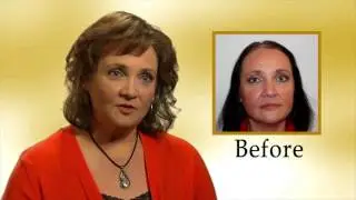 Female Hair Restoration at Transitions (Anne)