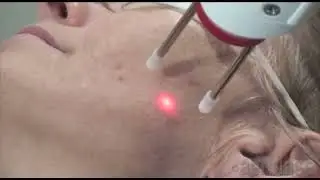 Treating hyperpigmentation with with 650 microsecond Technology