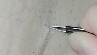 Most Oddly Satisfying Video • Underarm Hair Extractions (2022) • Armpit Hair Removal (With Tweezers)
