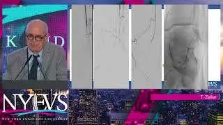 Role of Atherectomy Devices in My BTK Algorithm   Thomas Zeller