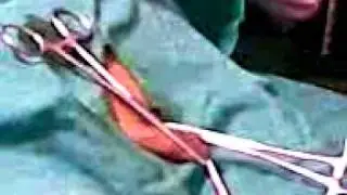 laser circumcision - Khitan part 3-3.3gp
