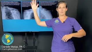 Prolotherapy for shoulder pain and arthritis: ways to determine if someone may be a candidate