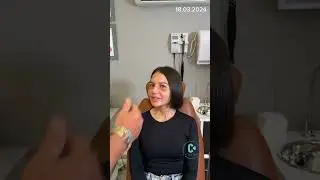 Rhinoplasty - 6th day follow-up after nose surgery.