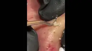 НОВОЕ ВИДЕО 2021  Прыщи давить залипательные