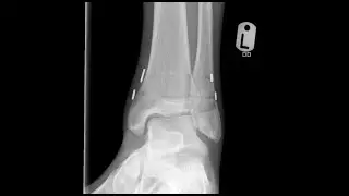 SHATTERED FIBULA & SYNDESMOTIC STABILISATION RECOVERY VIDEO