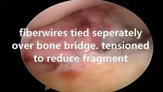 Dr Prathmesh jain's CRISS CROSS technique of ACL avulsion fixation