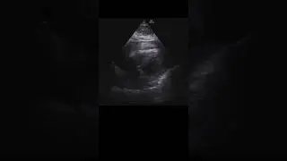 Hemopericardium #pocus #echo #echofirst #emergencymedicine #criticalcaremedicine
