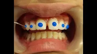 How aligner attachments are placed?
