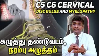 C5 C6 Cervical Disc Bulge and Myelopathy கழுத்து தண்டுவடம், நரம்பு அழுத்தம் Part 1