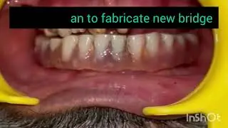 कैसे लगाए जाते हैं नए दांत, पूरी प्रक्रिया देखें इस वीडियो में #bridgemaking #new teeth