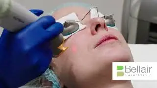 Laser Genesis #SkinRejuvenation