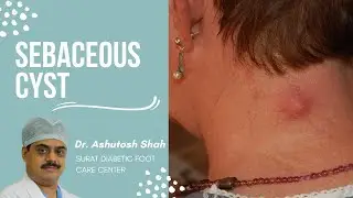 sebaceous cyst patient review, removal odsebaceous gland, રસોળીની ગાંઠ, Epidermoid cysts treatment.