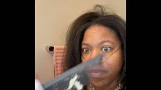 Dandruff Removal Extremely Huge Flakes , Itch & Scratch!