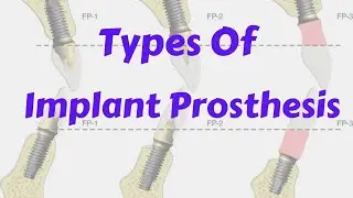 Classification Implant Supported Prosthesis- Fixed, Removable, Full arch || Implant Lecture Course