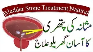 Bladder Stones || Treatment Without Surgery || (Masana Ki Pathri Ka Ilaj)