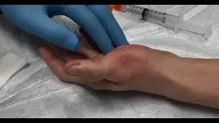 Dislocated thumb - Swan Neck Defirmity (corrected)