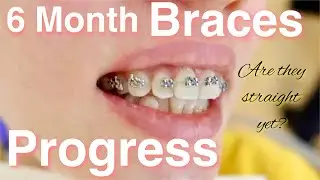 6 months braces progress in less than 2 minutes   Video and phone time lapse
