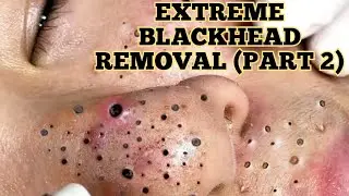 Relax Everyday Huge Blackhead Removal (PART 2)