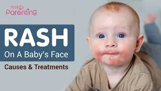 Rash On Baby's Face -  Reasons and Remedies