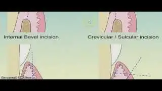 How to put internal bevel incision