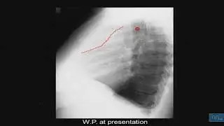 Virus et Lymphomes partie 06: cas clinique