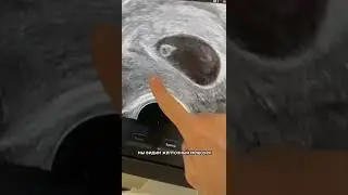 Ultrasound at 7 and 9 weeks of pregnancy