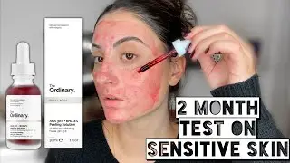 THE ORDINARY AHA 30% + BHA 2% PEELING SOLUTION ON ACNE PRONE, SENSITIVE SKIN | 2 Month Test